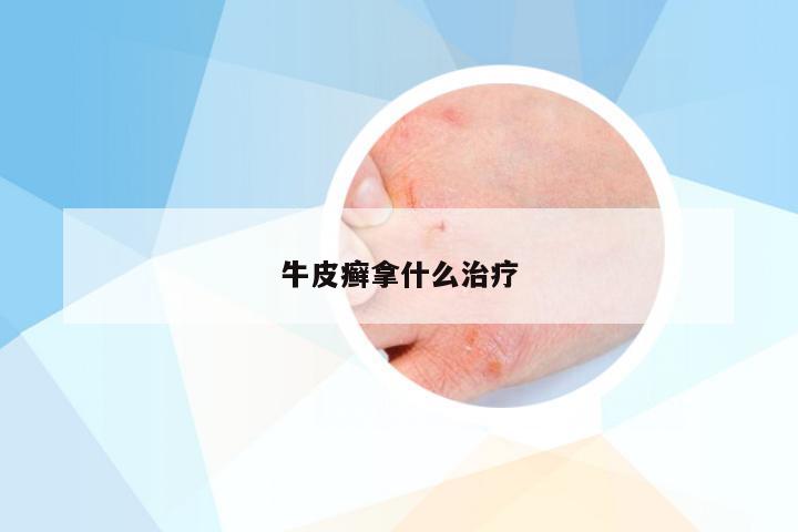 牛皮癣拿什么治疗