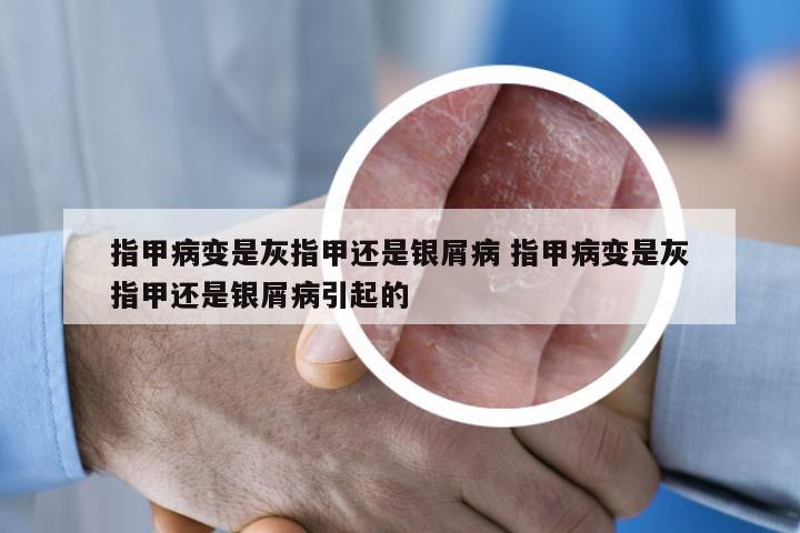 指甲病变是灰指甲还是银屑病 指甲病变是灰指甲还是银屑病引起的