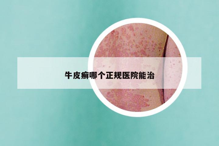 牛皮癣哪个正规医院能治