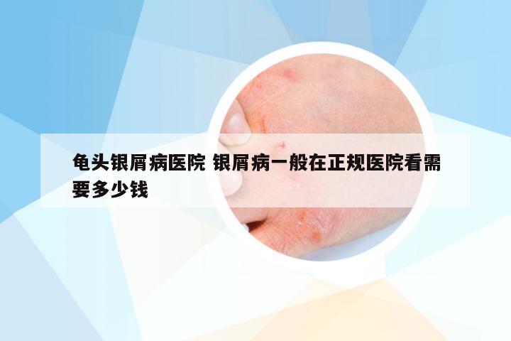 龟头银屑病医院 银屑病一般在正规医院看需要多少钱