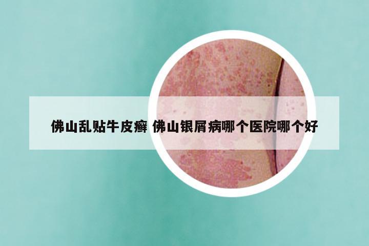 佛山乱贴牛皮癣 佛山银屑病哪个医院哪个好