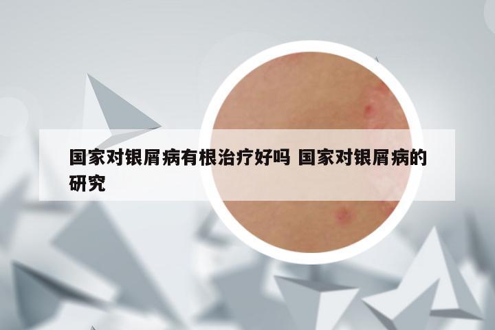 国家对银屑病有根治疗好吗 国家对银屑病的研究