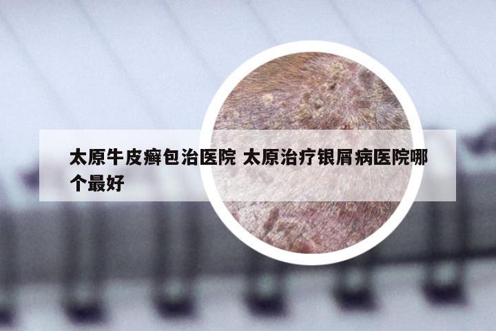 太原牛皮癣包治医院 太原治疗银屑病医院哪个最好