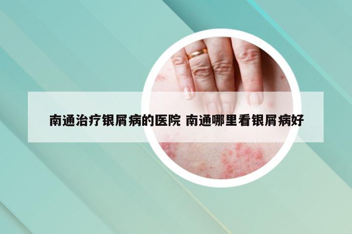 南通治疗银屑病的医院 南通哪里看银屑病好