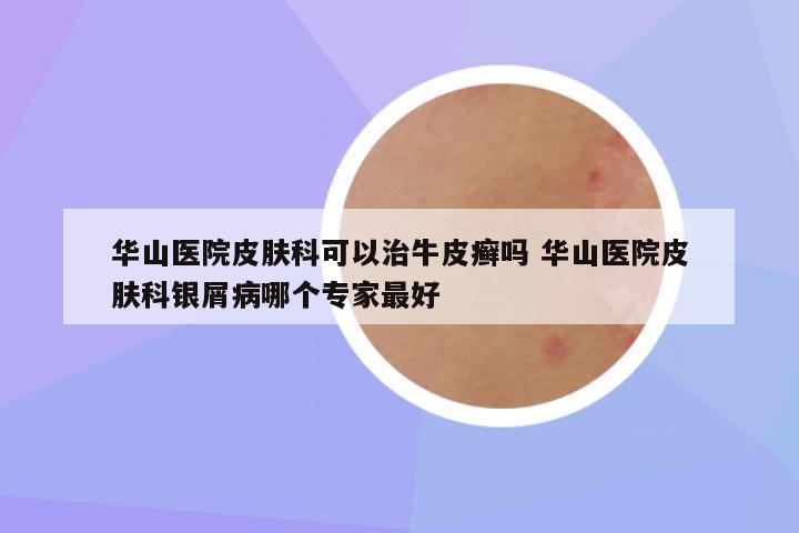 华山医院皮肤科可以治牛皮癣吗 华山医院皮肤科银屑病哪个专家最好