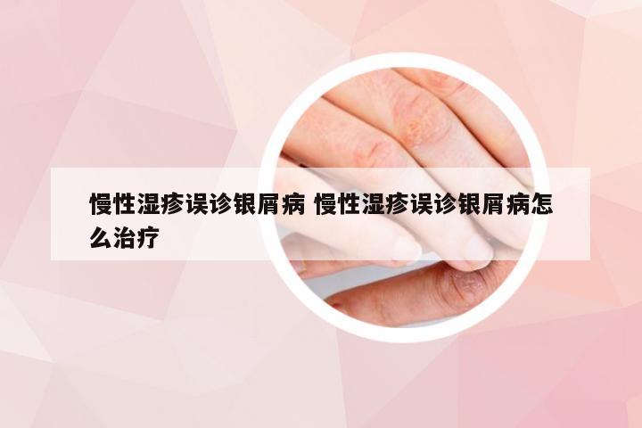 慢性湿疹误诊银屑病 慢性湿疹误诊银屑病怎么治疗