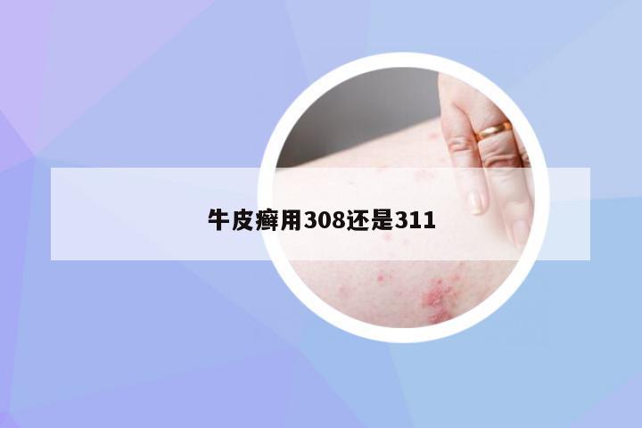 牛皮癣用308还是311