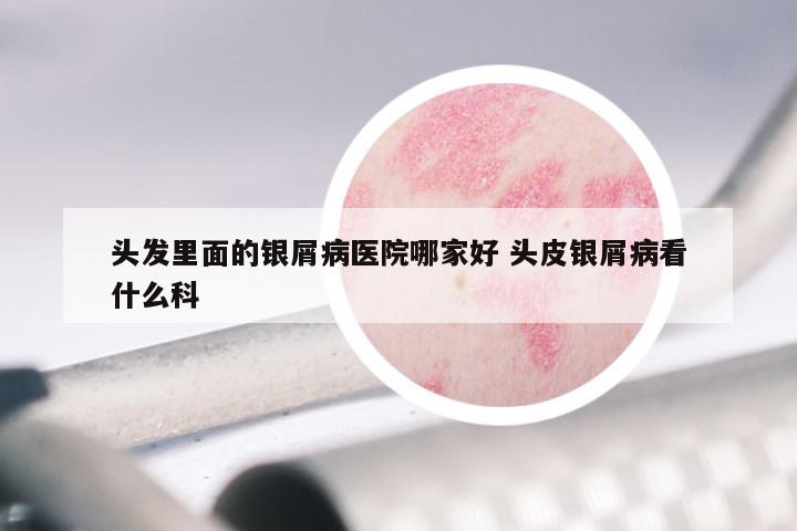 头发里面的银屑病医院哪家好 头皮银屑病看什么科