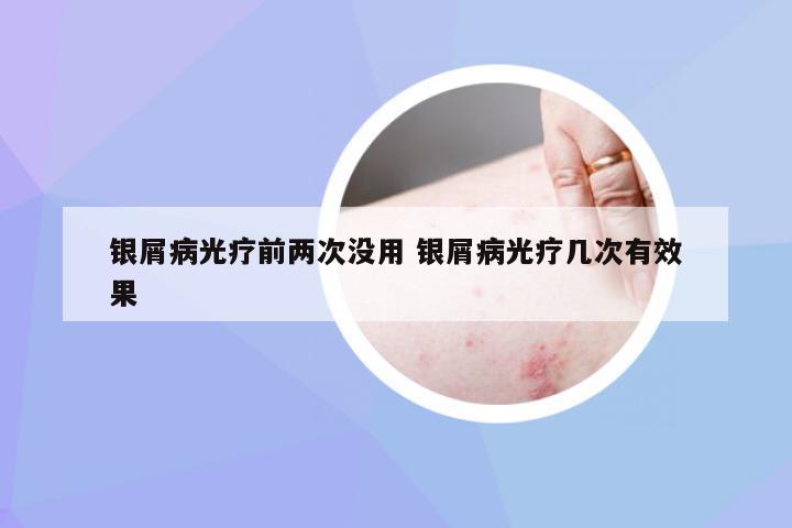 银屑病光疗前两次没用 银屑病光疗几次有效果