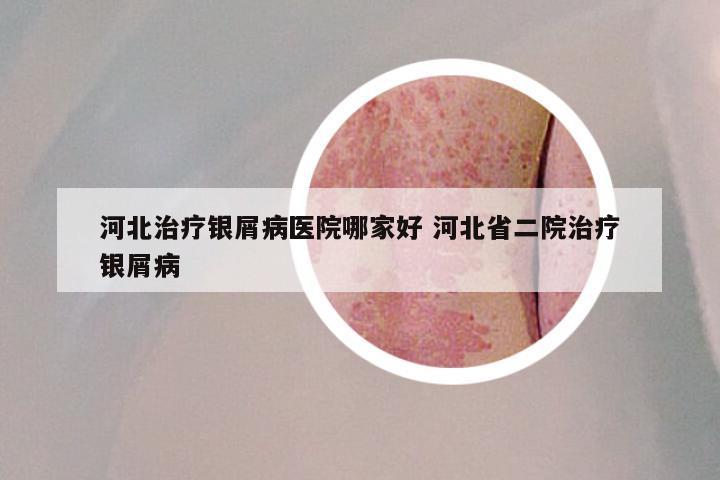 河北治疗银屑病医院哪家好 河北省二院治疗银屑病