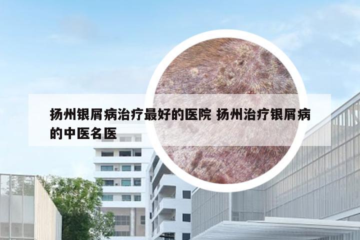 扬州银屑病治疗最好的医院 扬州治疗银屑病的中医名医