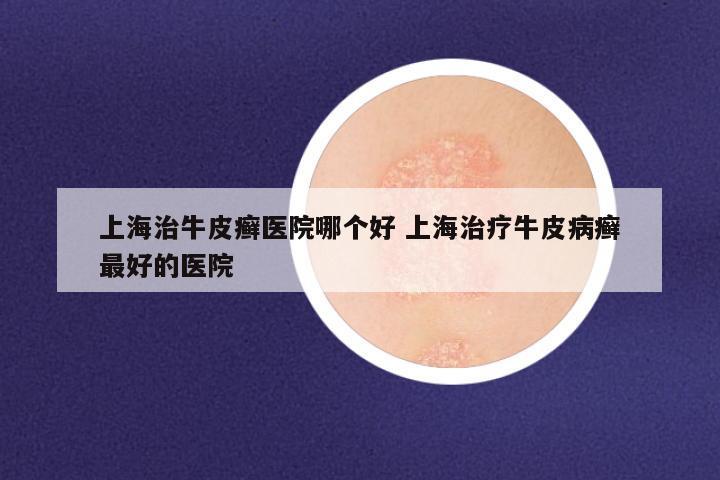 上海治牛皮癣医院哪个好 上海治疗牛皮病癣最好的医院