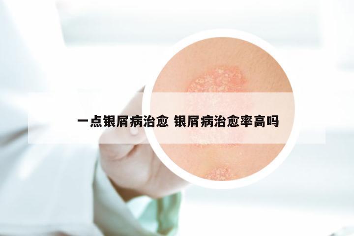 一点银屑病治愈 银屑病治愈率高吗