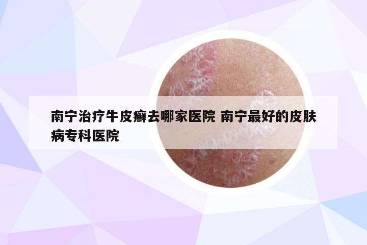 南宁治疗牛皮癣去哪家医院 南宁最好的皮肤病专科医院