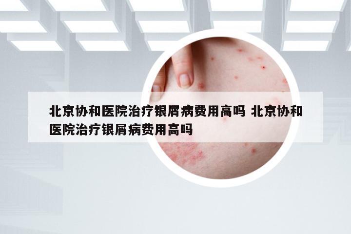 北京协和医院治疗银屑病费用高吗 北京协和医院治疗银屑病费用高吗