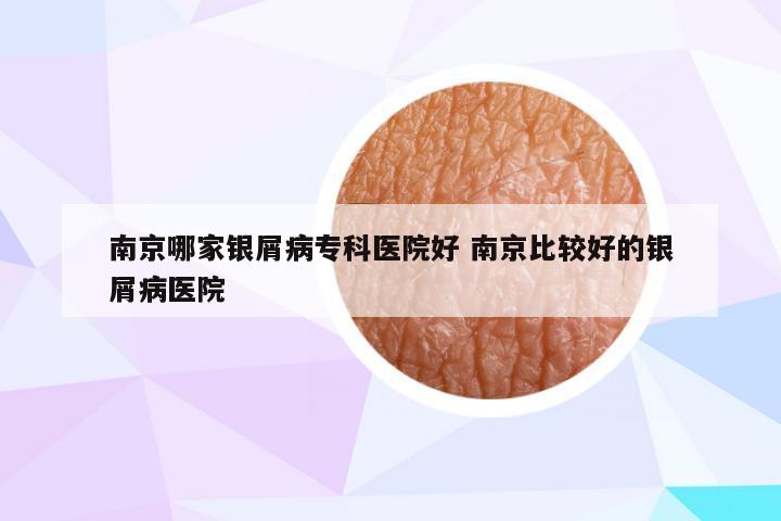 南京哪家银屑病专科医院好 南京比较好的银屑病医院
