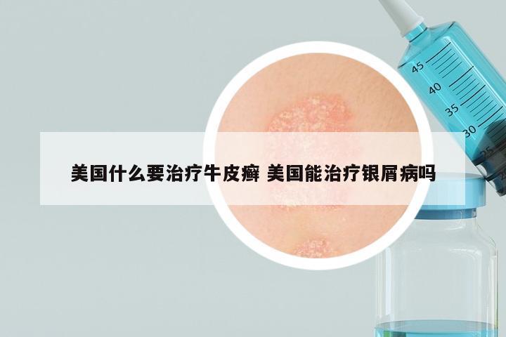美国什么要治疗牛皮癣 美国能治疗银屑病吗