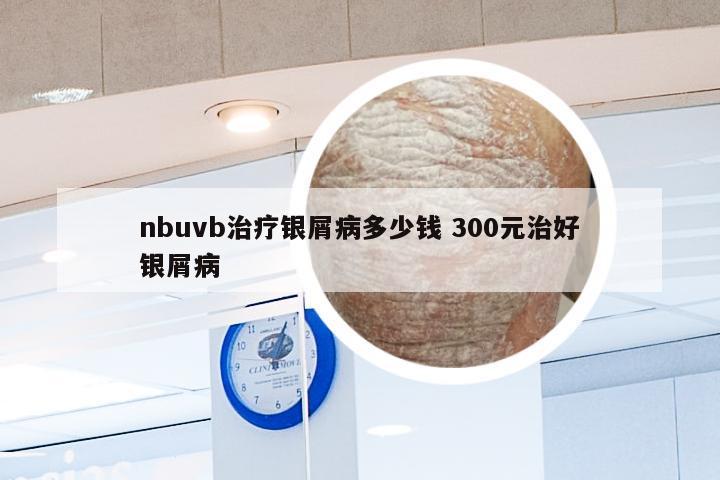 nbuvb治疗银屑病多少钱 300元治好银屑病