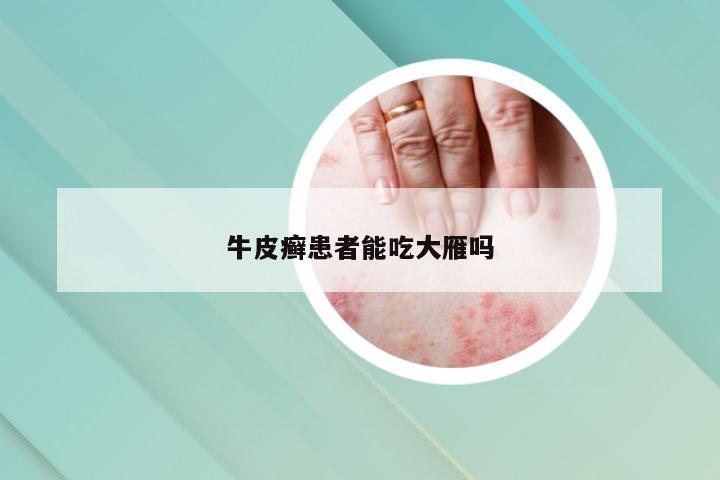 牛皮癣患者能吃大雁吗