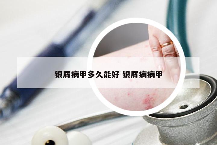 银屑病甲多久能好 银屑病病甲