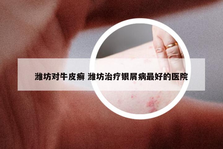 潍坊对牛皮癣 潍坊治疗银屑病最好的医院
