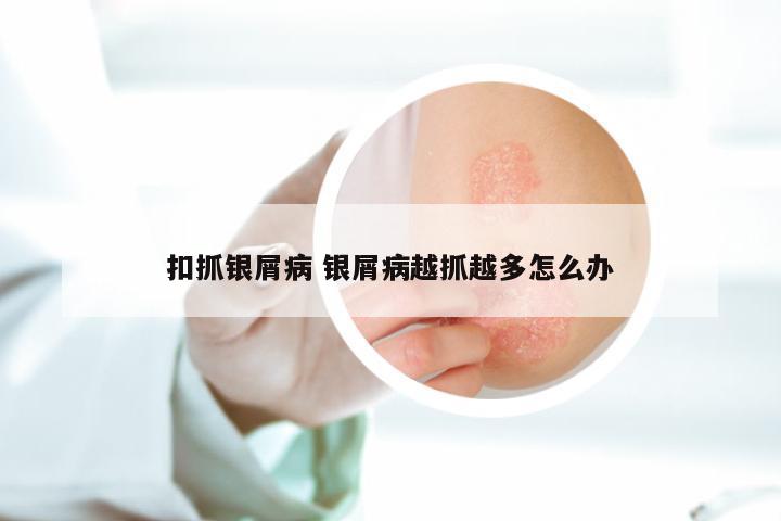 扣抓银屑病 银屑病越抓越多怎么办
