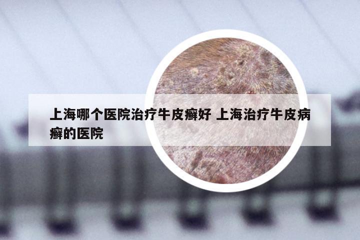 上海哪个医院治疗牛皮癣好 上海治疗牛皮病癣的医院
