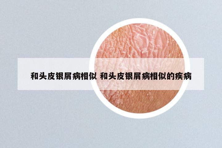 和头皮银屑病相似 和头皮银屑病相似的疾病