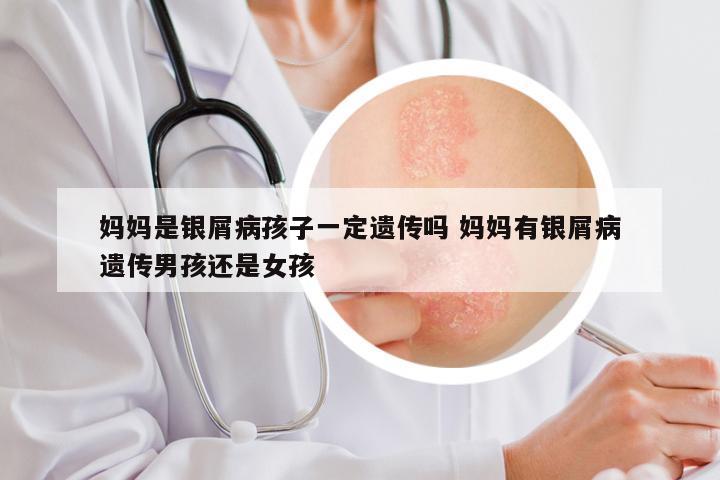 妈妈是银屑病孩子一定遗传吗 妈妈有银屑病遗传男孩还是女孩