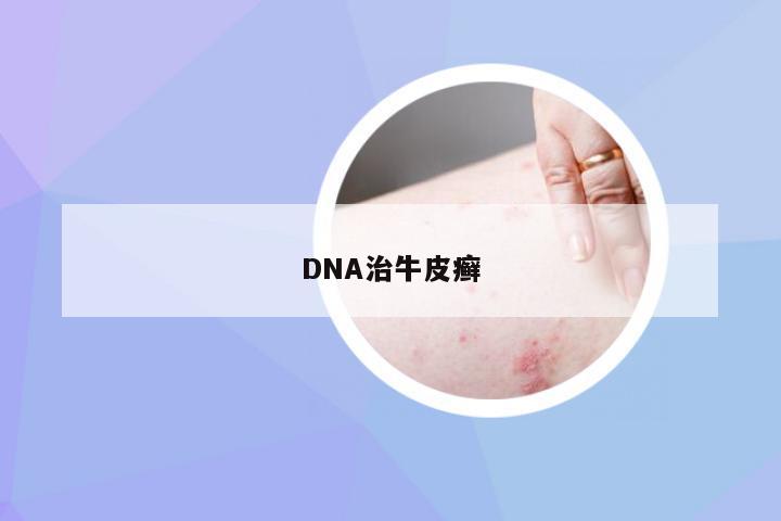DNA治牛皮癣