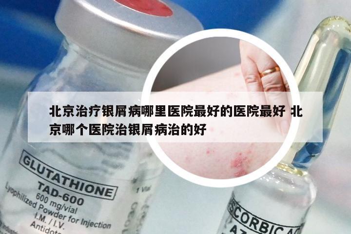 北京治疗银屑病哪里医院最好的医院最好 北京哪个医院治银屑病治的好
