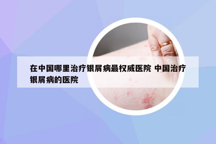 在中国哪里治疗银屑病最权威医院 中国治疗银屑病的医院