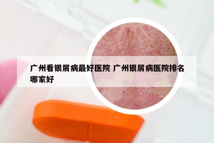 广州看银屑病最好医院 广州银屑病医院排名哪家好
