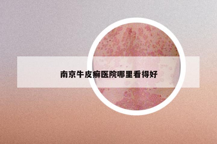 南京牛皮癣医院哪里看得好