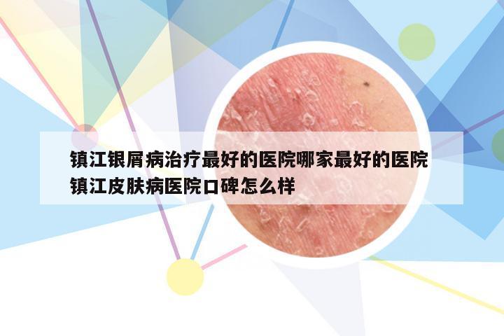 镇江银屑病治疗最好的医院哪家最好的医院 镇江皮肤病医院口碑怎么样