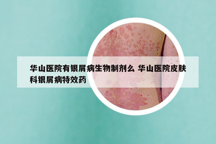 华山医院有银屑病生物制剂么 华山医院皮肤科银屑病特效药