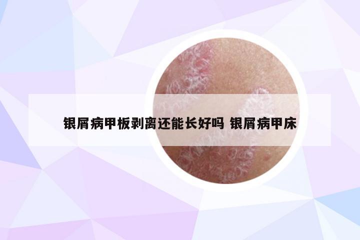 银屑病甲板剥离还能长好吗 银屑病甲床
