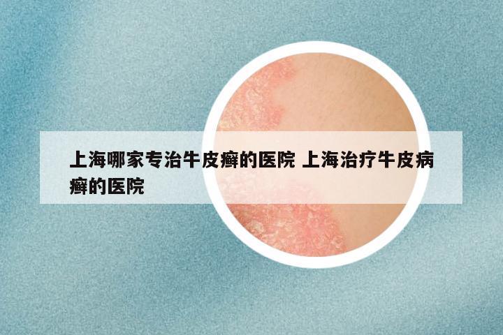 上海哪家专治牛皮癣的医院 上海治疗牛皮病癣的医院