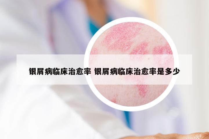 银屑病临床治愈率 银屑病临床治愈率是多少