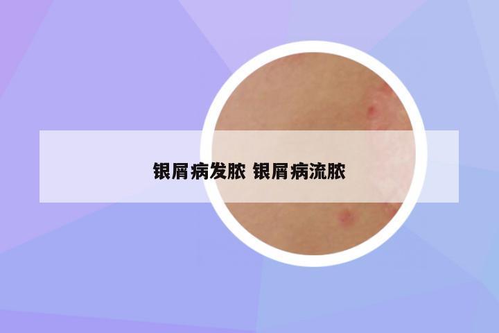 银屑病发脓 银屑病流脓