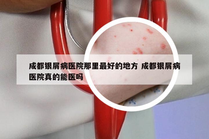 成都银屑病医院那里最好的地方 成都银屑病医院真的能医吗