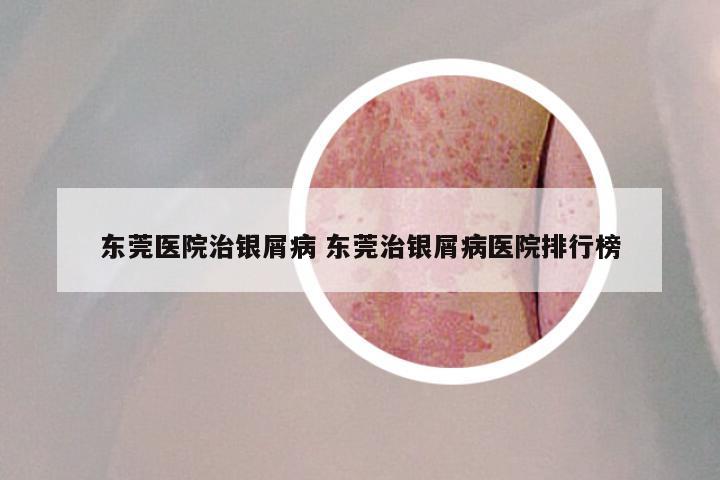 东莞医院治银屑病 东莞治银屑病医院排行榜