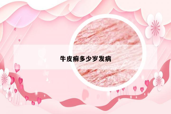 牛皮癣多少岁发病