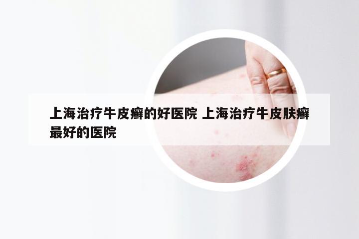 上海治疗牛皮癣的好医院 上海治疗牛皮肤癣最好的医院