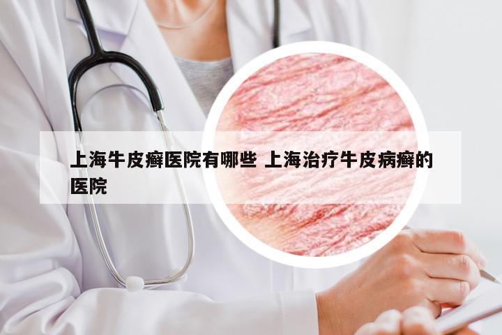 上海牛皮癣医院有哪些 上海治疗牛皮病癣的医院