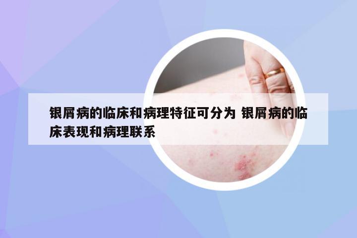 银屑病的临床和病理特征可分为 银屑病的临床表现和病理联系