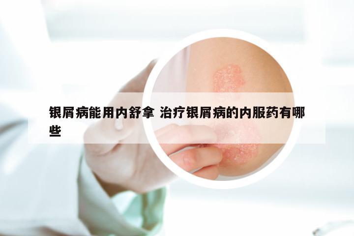银屑病能用内舒拿 治疗银屑病的内服药有哪些