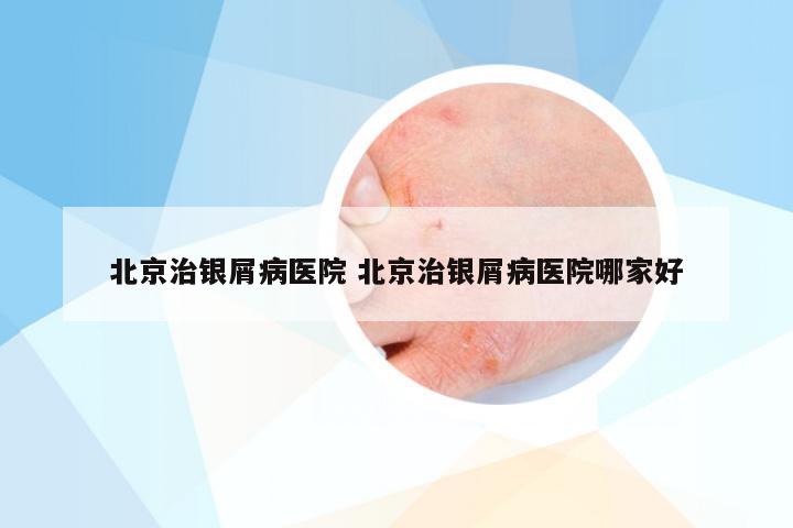 北京治银屑病医院 北京治银屑病医院哪家好