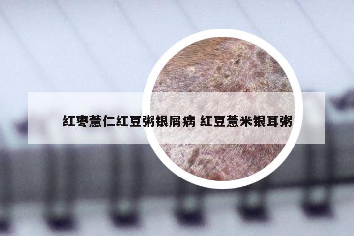 红枣薏仁红豆粥银屑病 红豆薏米银耳粥