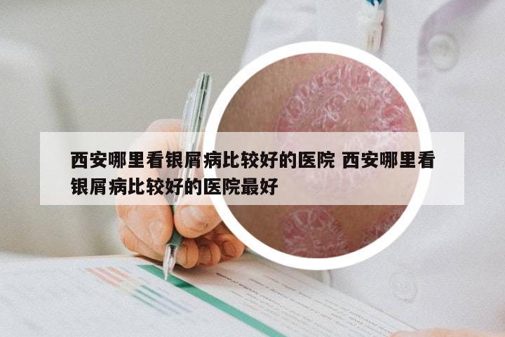 西安哪里看银屑病比较好的医院 西安哪里看银屑病比较好的医院最好